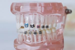 Moving Your Teeth With Braces